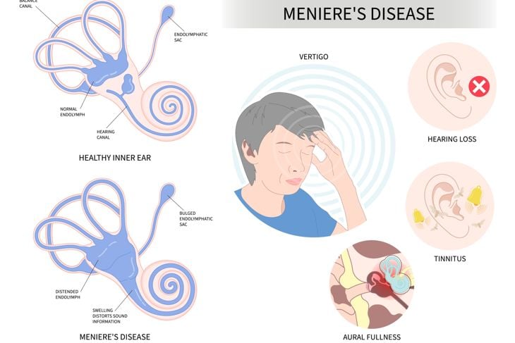 Symptoms of Headache with The Meniere's disease of sound in stuffy ear hear ringing roaring buzzing loss of balance dizzy spells pressure