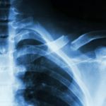 Causes, Symptoms, and Treatments for a Broken Collarbone