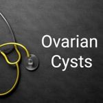 10 Symptoms and Treatments of Ovarian Cysts