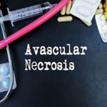 Understanding Avascular Necrosis: Causes and Risk Factors