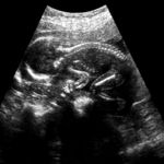 Causes and Risks of Low Amniotic Fluid