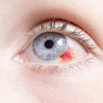 Subconjunctival Hemorrhages: When to See a Doctor