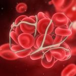 Everything You Need to Know About Phleboliths