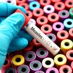 8 Symptoms of Measles