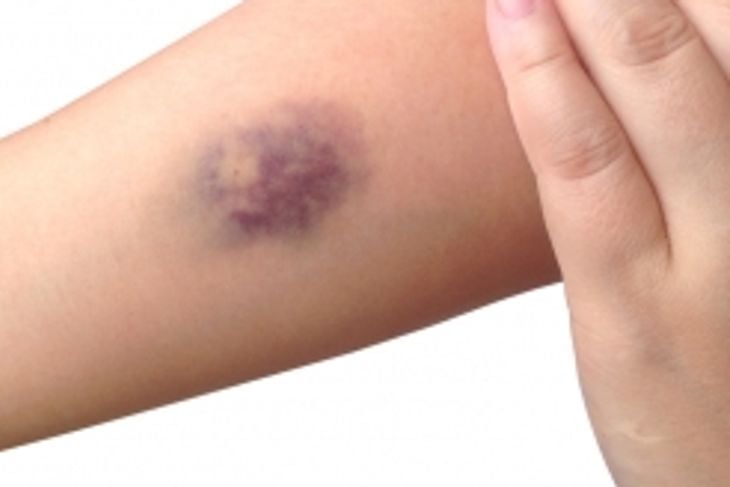 Understanding Random Bruising: 10 Possible Medical Reasons