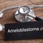 Understanding Ameloblastomas