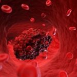 All About Blood Thinners