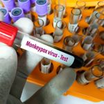 Understanding and Managing Mpox (Monkeypox)