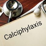 Causes, Symptoms and Treatment of Calciphylaxis