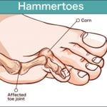Effective Natural Treatment Options for Hammer Toe