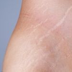 Treating Stretch Marks Naturally: Effective Solutions