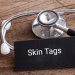 Skin Tags: A Comprehensive Guide to Their Ten Causes