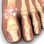 What are the Potential Complications of Gout?
