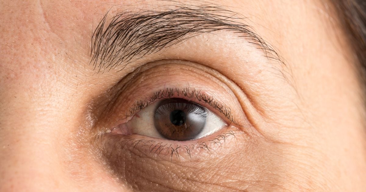 Why Do I Have Dark Circles Under My Eyes? Facty Health