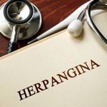 What is Herpangina?