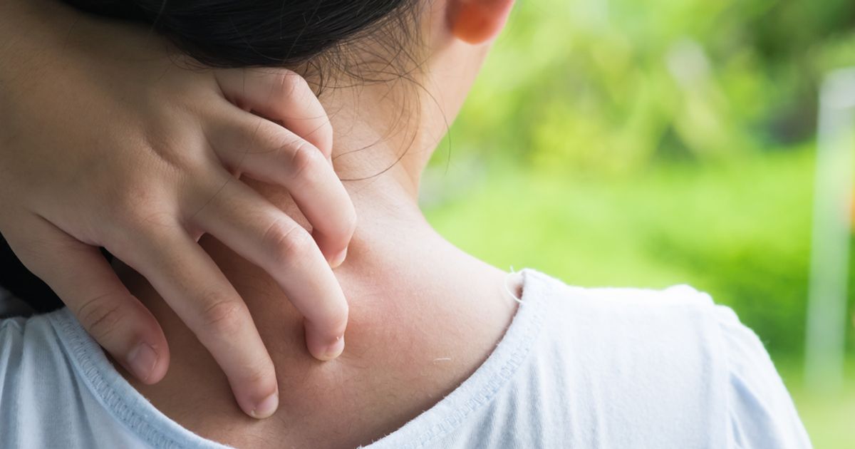 What You Need to Know About Swimmer's Itch Facty Health