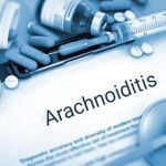 Causes, Symptoms, and Treatment Options for Arachnoiditis