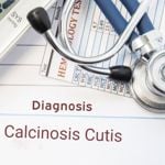 How Doctors Treat These 5 Types of Calcinosis Cutis