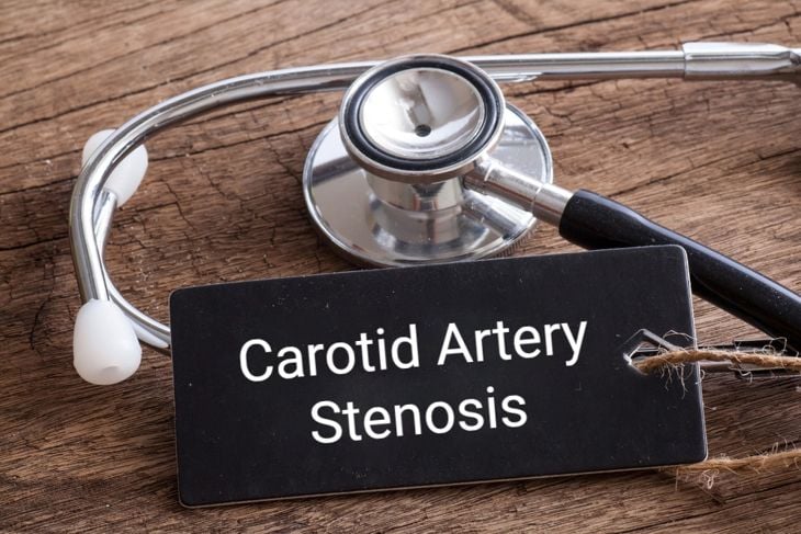 Understanding Carotid Artery Stenosis