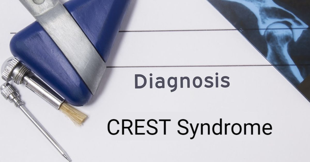 Characteristics and Causes of CREST Syndrome - Facty Health