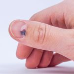 Blood Under the Nail: Subungual Hematoma