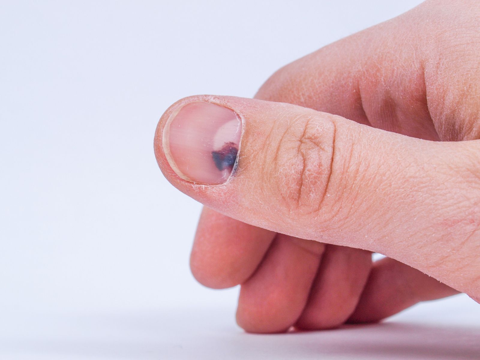 Experienced Toe Nail Fungus Surgeons In South Jersey | Rothman Orthopaedic  Institute