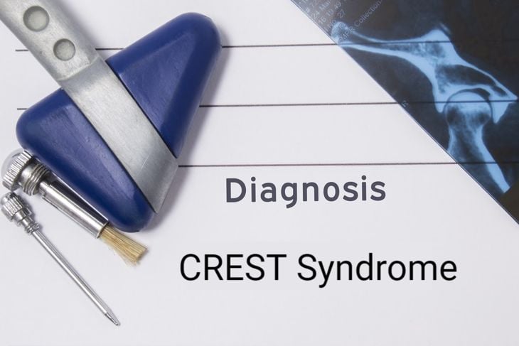 Characteristics and Causes of CREST Syndrome