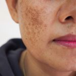 Hyperpigmentation and the Role of Melanin