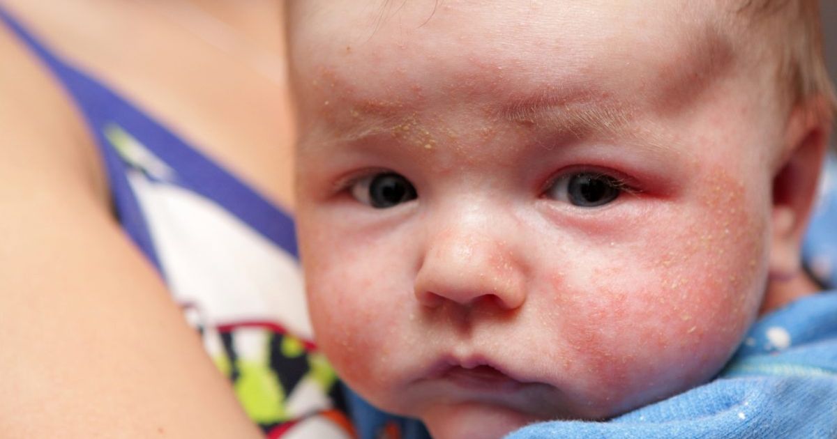 A Rash on Baby's Face Wait It Out, or Worry? Facty Health