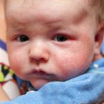 A Rash on Baby's Face: Wait It Out, or Worry?