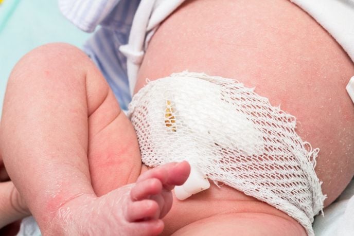 Belly Button Infections In Infants