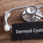 What are Dermoid Cysts?