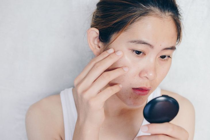 How to Get Rid of and Prevent Blackheads
