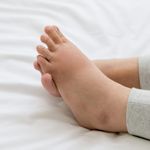 Elephantiasis: A Rare Tropical Disease