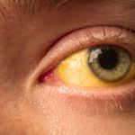 Medical Causes of Yellow Eyes