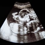 What to Expect With Twin Pregnancies
