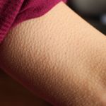 Serious and Not-So-Serious Causes of Goosebumps