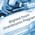 Anembryonic Pregnancy and a Blighted Ovum