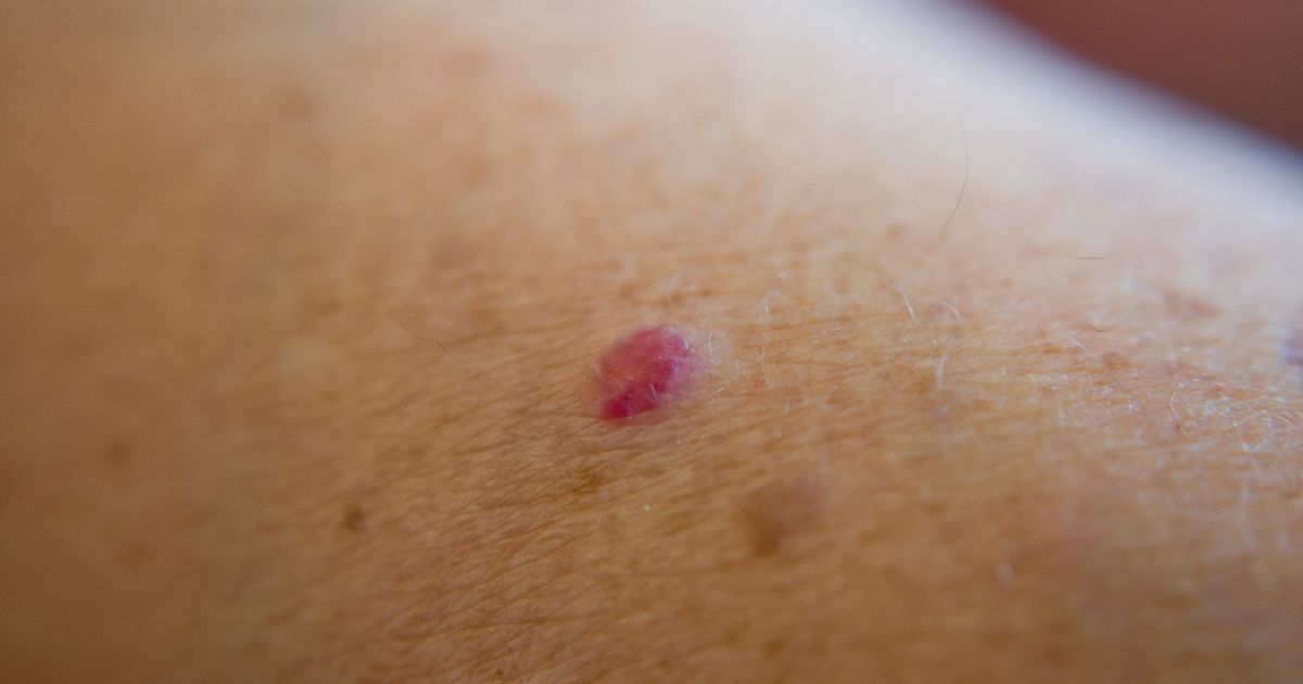 Common, Benign Cherry Angiomas Facty Health