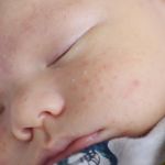 Baby Acne is a Common Issue