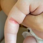 Heat Rash in Infants and Children