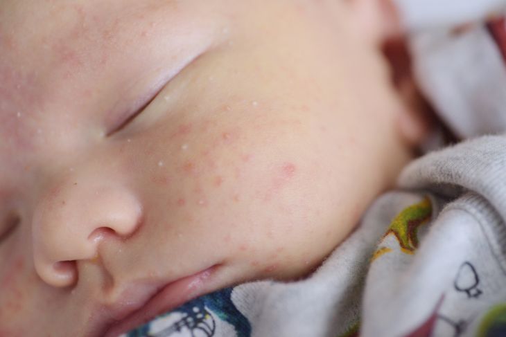Baby Acne is a Common Issue