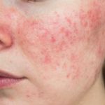 Demodex Mites: Diagnosis, Treatment, and Prevention