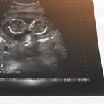 Conjoined Twin in Pregnancy and Beyond