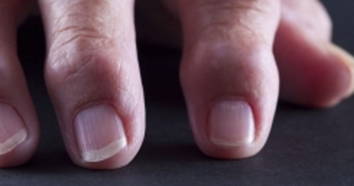 The Causes and Effects of Heberden's Nodes Facty Health