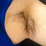 The Mechanisms and Management of Hypertrichosis
