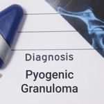 Pyogenic Granuloma: A Common Vascular Tumor