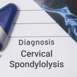 Cervical Spondylolysis: Fractures of the Cervical Vertebrae