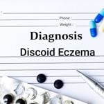 Causes, Symptoms, and Treatments of Discoid Eczema