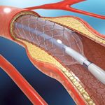 Types of Stents and Their Purposes